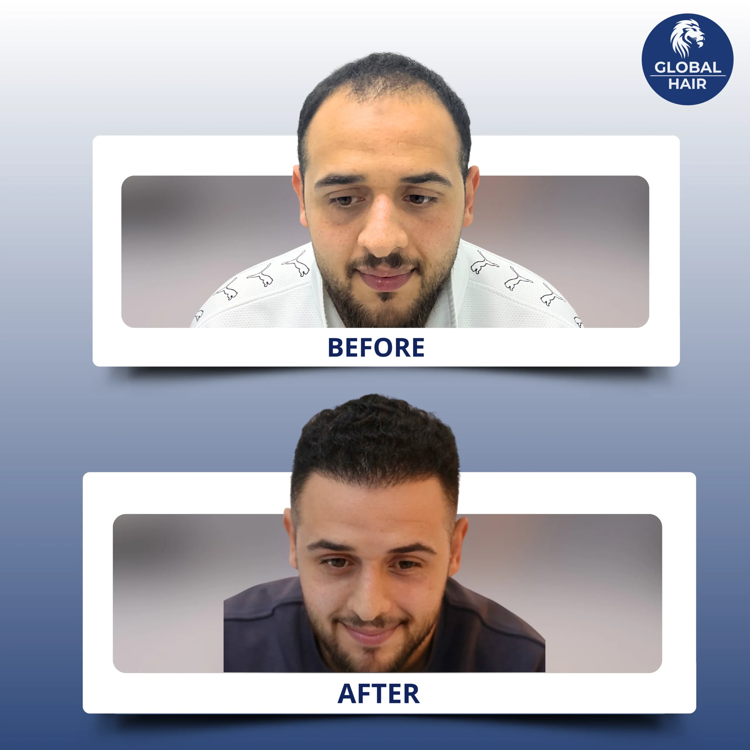 قبل وبعد زراعه مقدمه الرأس في جلوبال هير بي