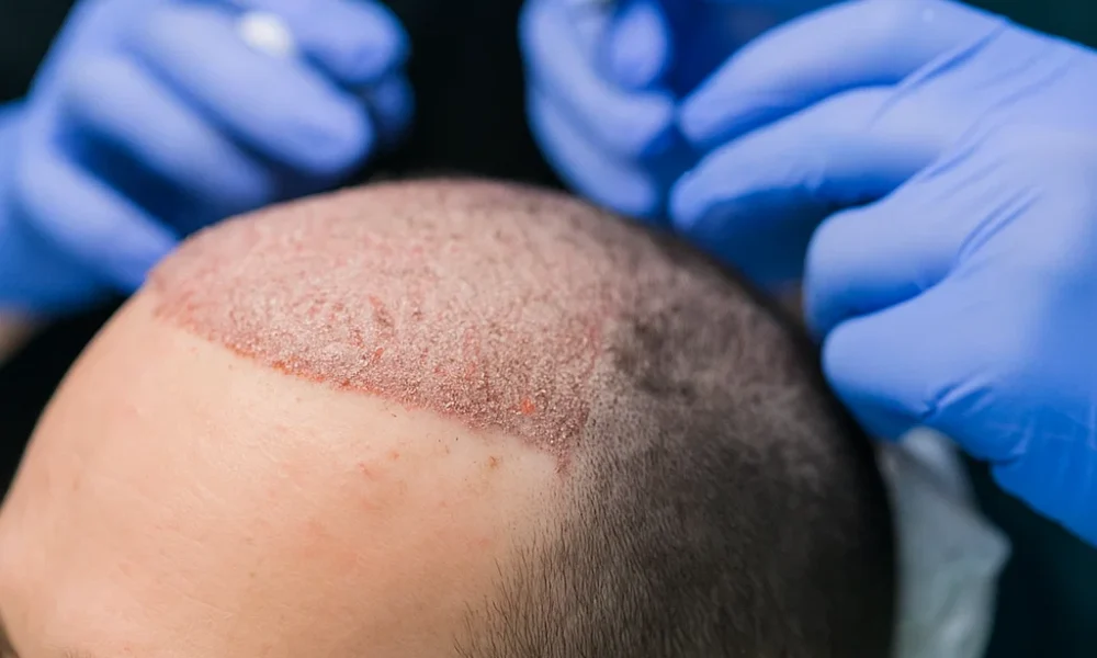 Hair Transplant in Dubai – Boost Confidence with Expert Solutions