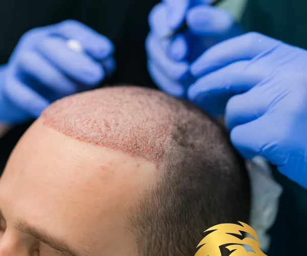 Hair Transplant in Dubai – Boost Confidence with Expert Solutions