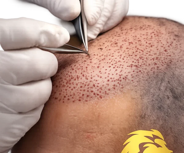 Best Hair Transplant Techniques in Dubai