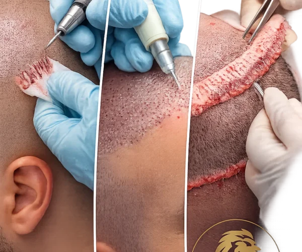 Best Hair Transplant Techniques in Dubai