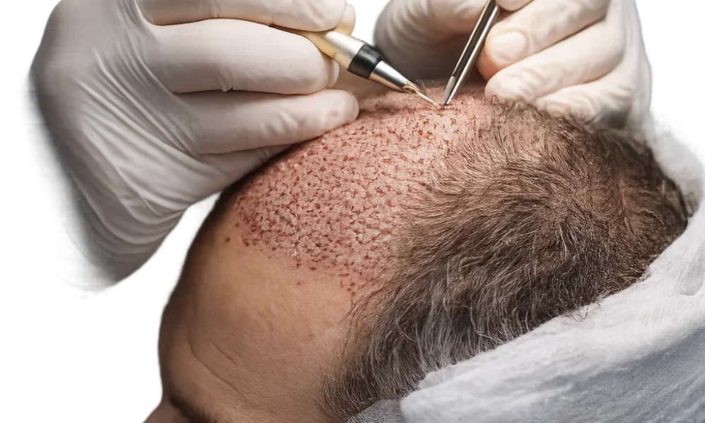 Best Hair Transplant Techniques in Dubai