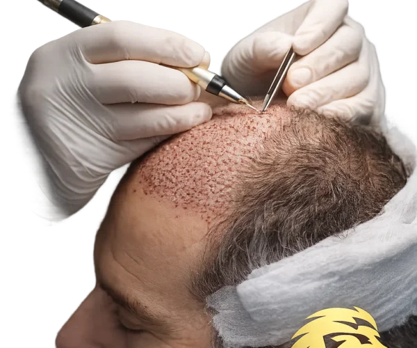 Best Hair Transplant Techniques in Dubai