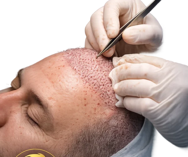 Best Hair Transplant Techniques in Dubai (2025 Guide)