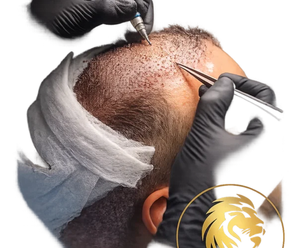 Hair Transplant Cost in Dubai