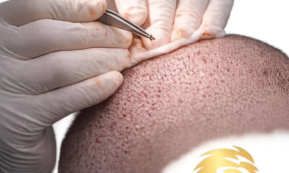 Hair transplant in Dubai performed at Global Hair Dubai, the best hair transplant clinic in Dubai