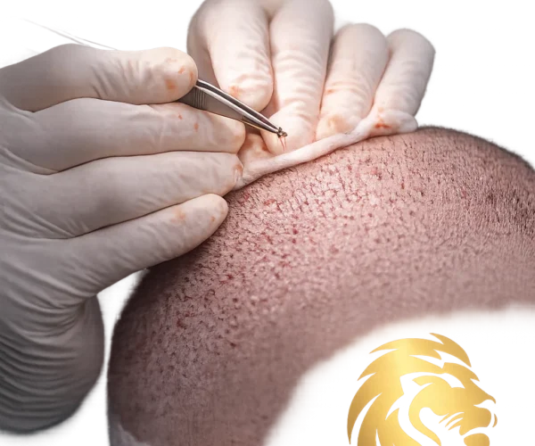 Hair transplant in Dubai performed at Global Hair Dubai, the best hair transplant clinic in Dubai