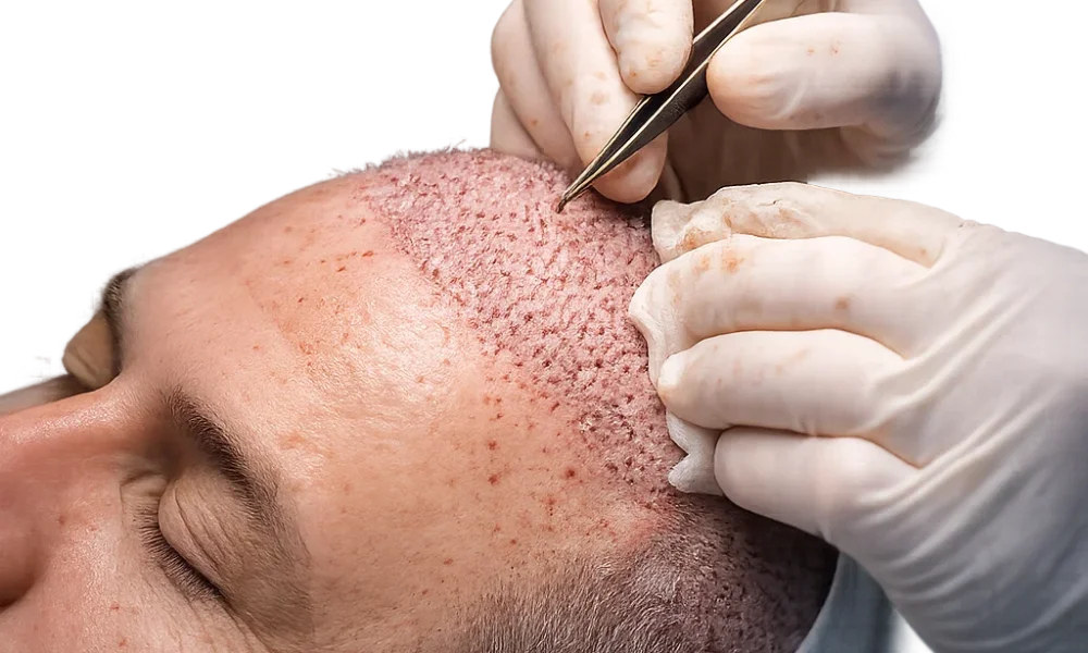 Hair Transplant Without Shaving in Dubai – Is It Possible in 2025